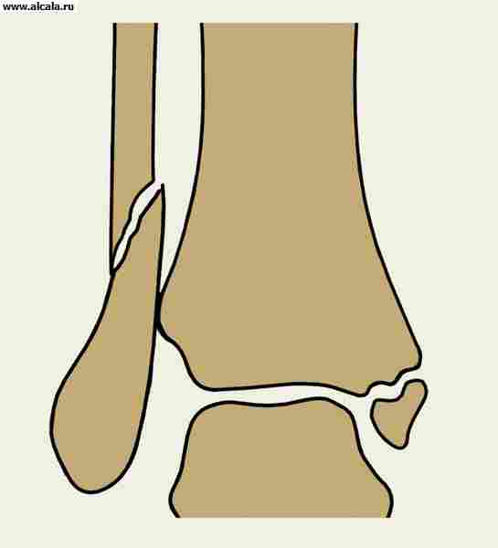 Рис. 1. Схематическое изображение голеностопного сустава при переломе Дюпюитрена (прямая проекция): видны линии перелома медиальной лодыжки и малоберцовой кости.