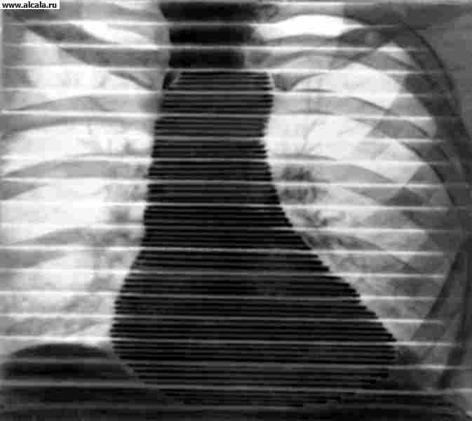 Рис. 1. Рентгенокимограмма сердца (передняя проекция): норма.
