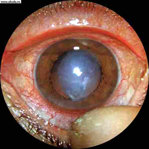 Рис. 4. Вид глаза при дисковидном кератите: определяется глубокий стромальный инфильтрат в виде диска без изъязвления.