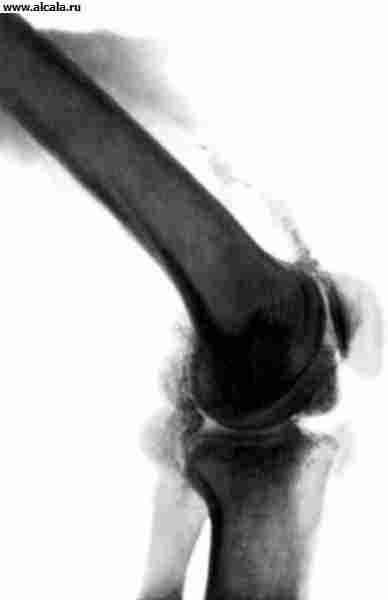 Рис. 26. Рентгенограмма коленного сустава при хондроматозе.