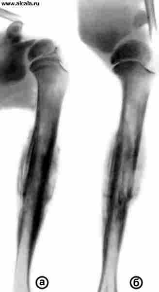 Рис. 1. Рентгенограммы плечевой кости и плечевого сустава (а — прямая, б — аксиальная проекции) при опухоли Юинга у ребенка 10 лет: отмечается многослойная периостальная реакция на протяжении всего диафиза.