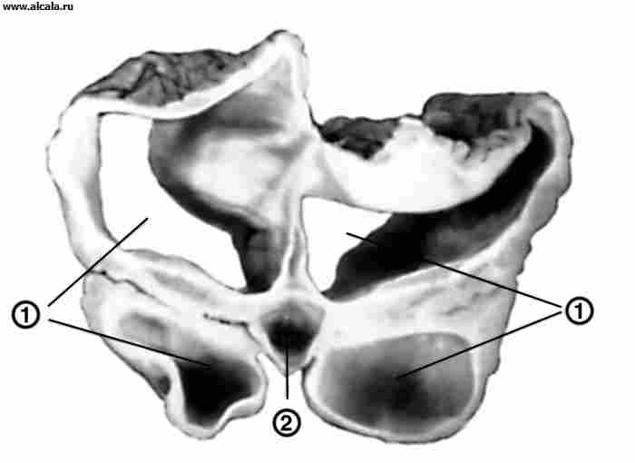 Рис. 1. Макропрепарат головного мозга (фронтальный разрез) при гидроцефалии: боковые(1) и третий(2) желудочки резко расширены.