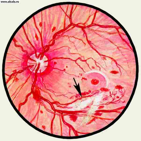 Рис. 15. Глазное дно в норме и при патологии. Прогрессирующая диабетическая ретинопатия: стрелкой указан соединительнотканный тяж.