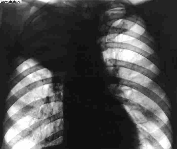 Рис. 2а). Рентгенограмма грудной клетки при ателектазе верхней доли правого легкого (прямая проекция): верхняя доля правого легкого уменьшена в объеме, гомогенно затенена.