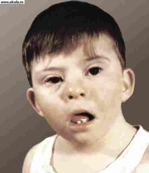 Рис. 1а). Некоторые внешние признаки болезни Дауна у ребенка 4 лет: косо расположенные глазные щели, эпикант, уплощенная широкая переносица, полуоткрытый рот, деформированные ушные раковины.