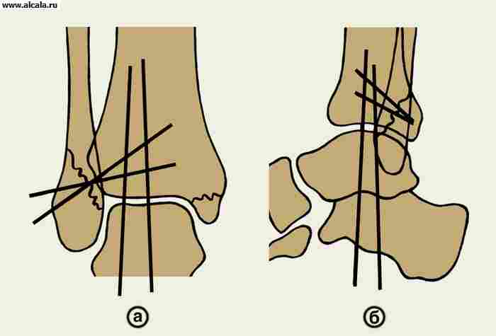 Рис. 3. Схематическое изображение голеностопного сустава при переломе Дюпюитрена в прямой (а) и боковой (б) проекции после закрытой чрескожной фиксации спицами: вертикальные спицы фиксируют голеностопный сустав, другие — синдесмоз.