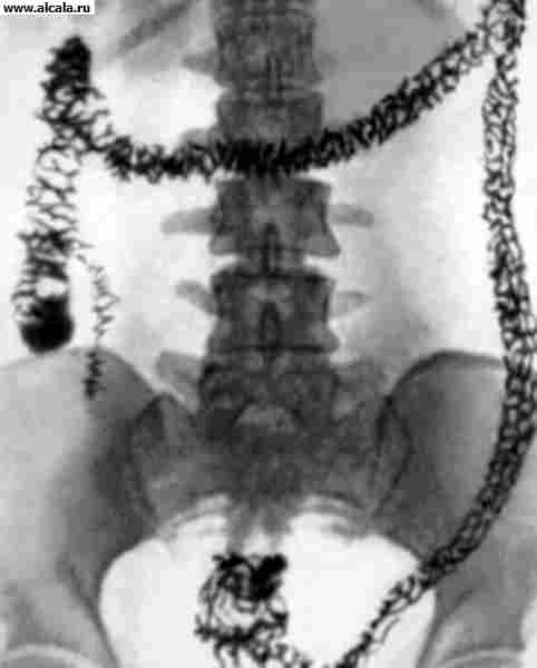 Рис. 1б). Обзорная рентгенограмма толстой кишки в норме после удаления из кишечника рентгеноконтрастной взвеси.