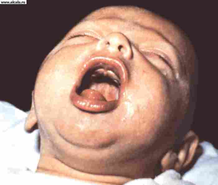 Рис. 1б). Внешний вид ребенка, больного коклюшем, во время приступа спазматического кашля: разгар приступа.