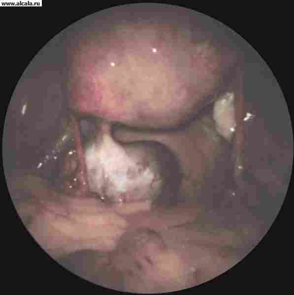 Рис. 4а). Лапароскопическая картина при некоторых гинекологических заболеваниях — серозная киста яичника.