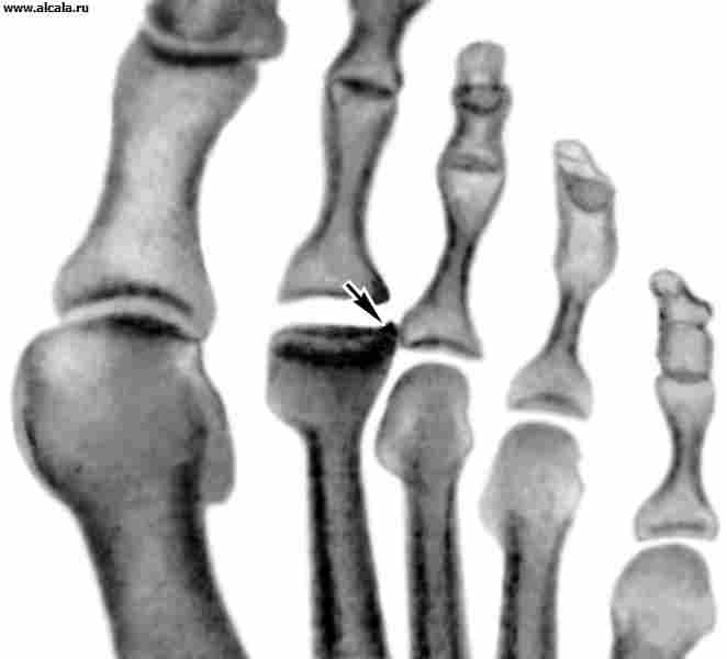Рис. 2а). Рентгенограммы переднего отдела стоп больных с различными стадиями болезни Келера II (патологические изменения указаны стрелками): уплощение суставной головки II плюсневой кости.