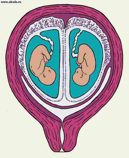 Рис. 2. Схематическое изображение плодов (показано на разрезе), развивающихся в матке из двух яйцеклеток, имплантировавшихся близко друг к другу (двуяйцовая двойня): 1 — плацента, 2 — амнионы, 3 — хорионы, 4 — капсулярная децидуальная оболочка, 5 — париетальная децидуальная оболочка.