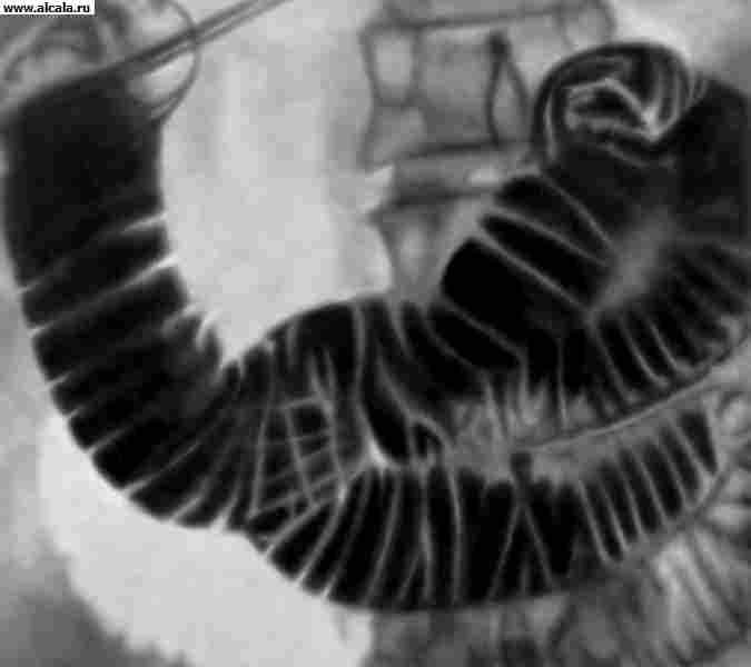 Рис. а). Рентгенограмма двенадцатиперстной кишки в условиях ее искусственной гипотонии: в норме (дано для сравнения).