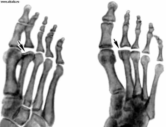 Рис. 2в). Рентгенограммы переднего отдела стоп больных с различными стадиями болезни Келера II (патологические изменения указаны стрелками): деформирующий артроз II плюснефалангового сочленения (слева косая проекция).