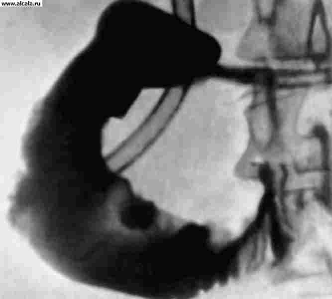 Рис. б). Рентгенограмма двенадцатиперстной кишки в условиях ее искусственной гипотонии: при раке фатерова соска; стрелкой указан бугристый дефект контрастирования в нисходящей части кишки.