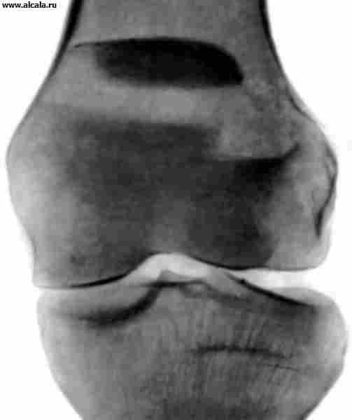 Рис. 21а). Рентгенограмма коленного сустава при поперечном переломе надколенника с расхождением отломков: прямая проекция.