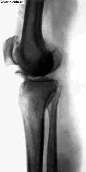 Рис. 25. Рентгенограмма коленного сустава при болезни Левена, сопровождающейся образованием внутрисуставных тел.