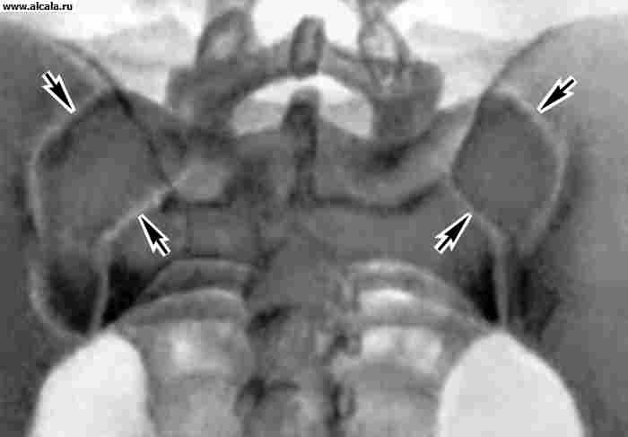 Рис. 3. Рентгенограмма крестцово-подвздошных суставов в норме (прямая задняя проекция): стрелками указаны передние и задние края суставных щелей.