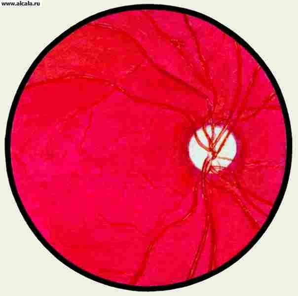 Рис. 4. Глазное дно в норме и при патологии. Первичная атрофия зрительного нерва: диск зрительного нерва бледный, почти белого цвета, границы четкие, артериальные сосуды узкие.