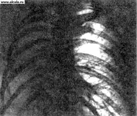 Рис. 1. Рентгенограмма грудной клетки (прямая проекция) при ателектазе правого легкого: правое легочное поле интенсивно затенено, органы средостения смещены вправо.