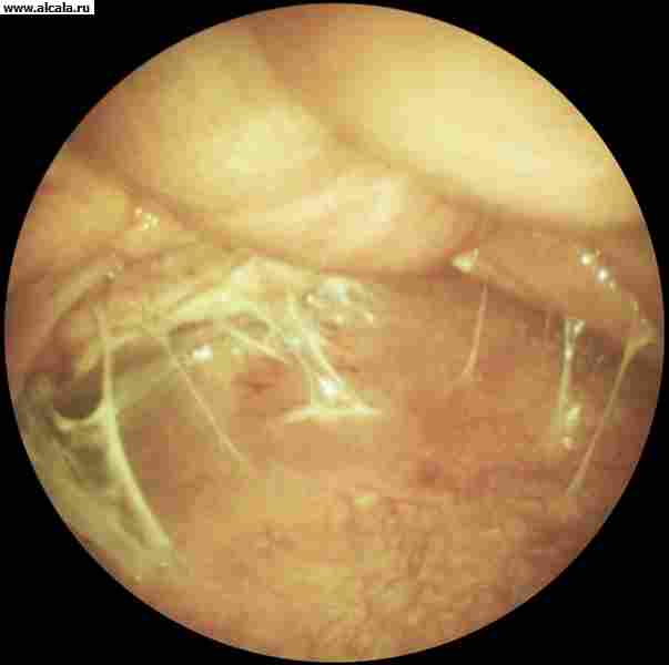 Рис. 2г). Лапароскопическая картина при некоторых заболеваниях и патологических состояниях органов брюшной полости — фиброзный перитонит.