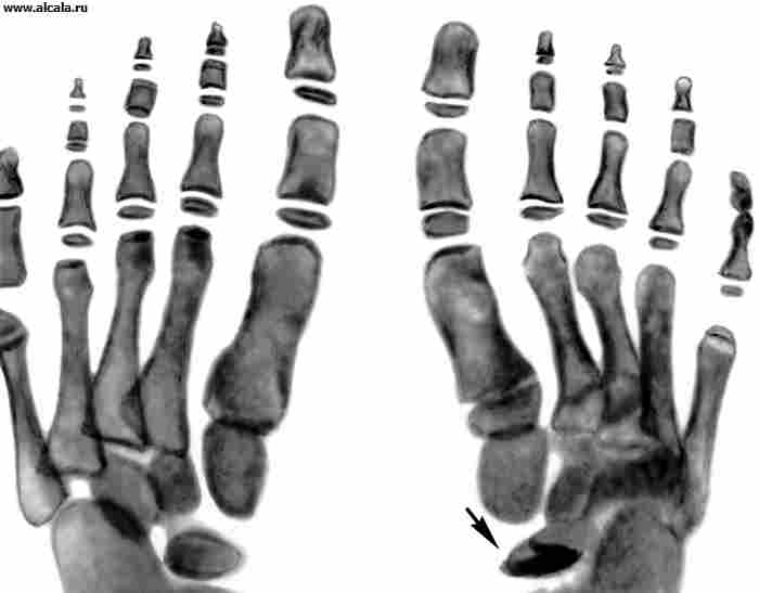 Рис. 1а). Рентгенограммы стоп ребенка 6 лет при болезни Келера I: в прямой проекции — ладьевидная кость правой стопы деформирована (указана стрелкой), состоит из отдельных плотных фрагментов; ладьевидная кость левой стопы не изменена.