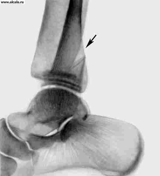 Рис. 2б). Рентгенограмма голеностопного сустава при переломе Дюпюитрена: в боковой проекции (стрелкой указано место перелома малоберцовой кости).