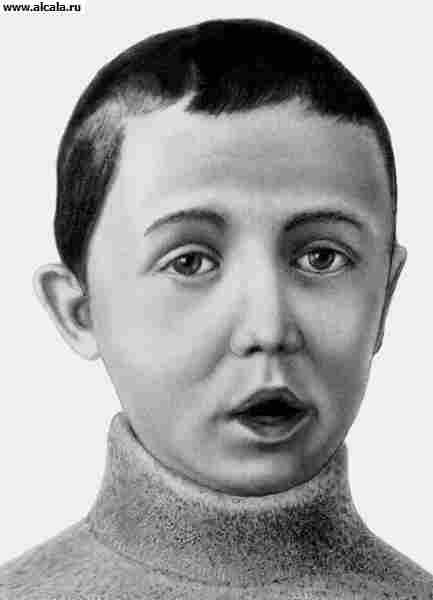 Рис. 2. Типичное выражение лица ребенка при аденоидах.
