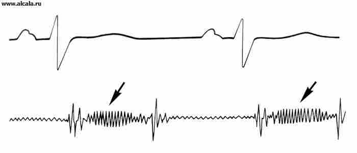 Рис. 5. Фонокардиограмма при органической недостаточности трехстворчатого клапана: низкоамплитудный лентовидный систолический шум (указан стрелками).
