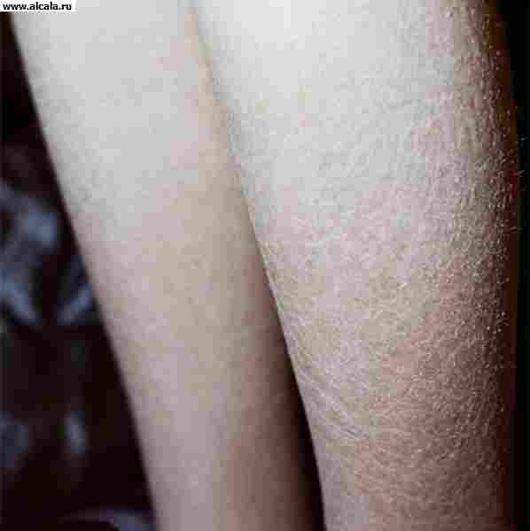 Рис. 1. Голени больной с обыкновенным ихтиозом: поражение кожи в виде мелких тонких серовато-черных чешуек.