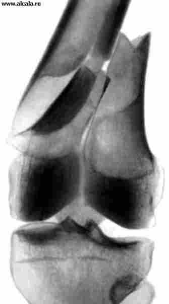 Рис. 22а). Рентгенограмма коленного сустава при переломе обоих мыщелков бедренной кости со смещением: прямая проекция.