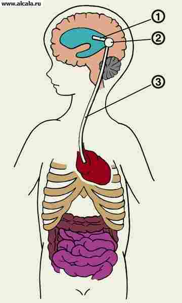 Рис. 5. Схема вентрикулоатриального шунтирования при гидроцефалии: 1 — катетер, введенный в боковой желудочек головного мозга; 2 — помпа; 3 — катетер, введенный в ушко правого предсердия.