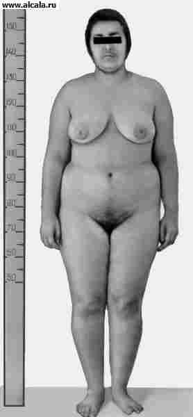 Рис. 2. Больная 16 лет с пубертатно-юношеским диспитуитаризмом: характерны «нижний» тип ожирения, гирсутизм.