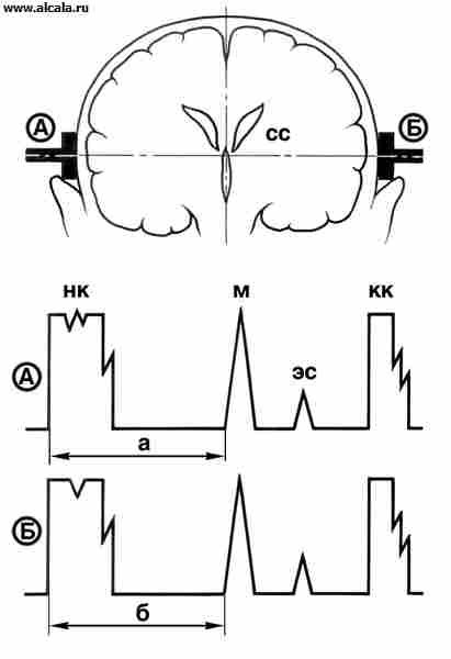 Рис. 1. Схематическое изображение эхоэнцефалограмм в норме: вверху — фронтальный разрез головы с расположенными в височных областях ультразвуковыми датчиками (А, Б), ниже размещены эхоэнцефалограммы (А — правая, Б — левая); СС — срединные структуры (третий желудочек головного мозга), М — эхосигнал от срединных структур мозга (М-эхо), ЭС — эхосигнал от различных несрединных структур мозга, НК — начальный комплекс, КК — конечный комплекс; в норме расстояние а на эхоэнцефалограмме, полученной при установке датчика справа, равно расстоянию б на кривой, полученной при установке датчика слева.