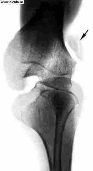 Рис. 14. Рентгенограмма коленного сустава при врожденном вывихе дольчатого надколенника (указан стрелкой).