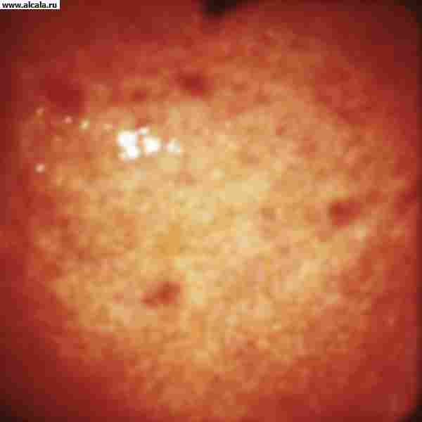 Рис. 5. Эндоскопическая картина желудка в норме и при различных заболеваниях. Острые геморрагические эрозии желудка на фоне атрофического гастрита.