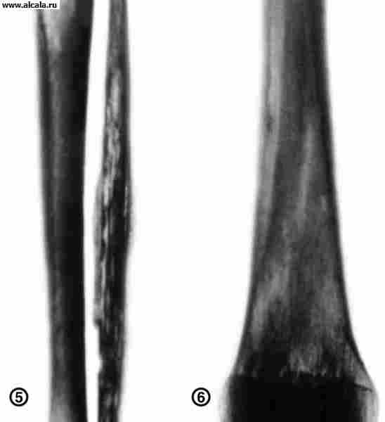 Рис. 5. Рентгенограмма костей голени при остром лейкозе (прямая проекция): очаги деструкции по всей толщине малоберцовой кости.